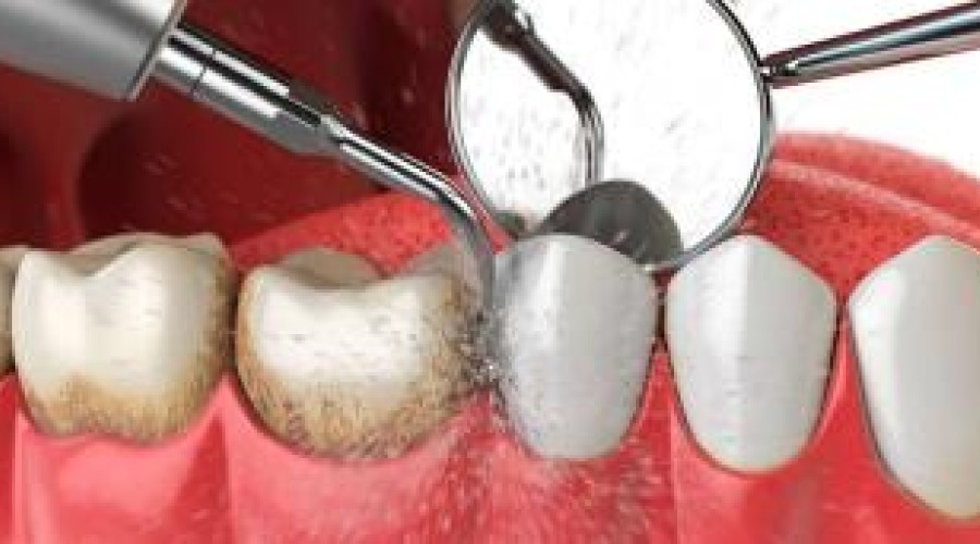 Профессиональная чистка зубов ультразвуковым способом: всё о процедуре
